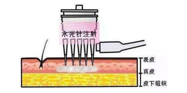 自己打水光針會導致面癱嗎